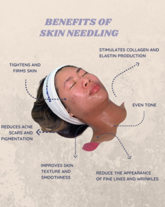 microneedling treatment