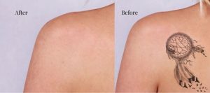 tattoo removal services